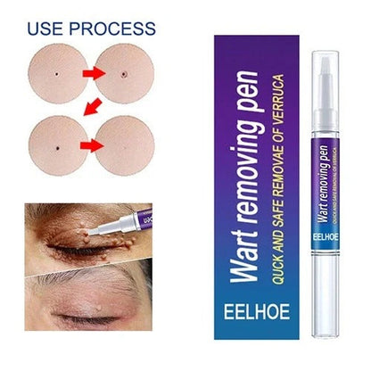 Warts, Moles & Skin Tag Remover Pen