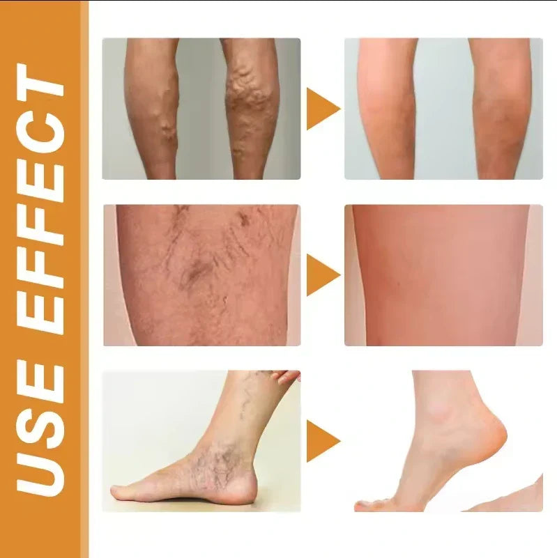 Turmeric Vericose Vein Relief Spray ( Imported )