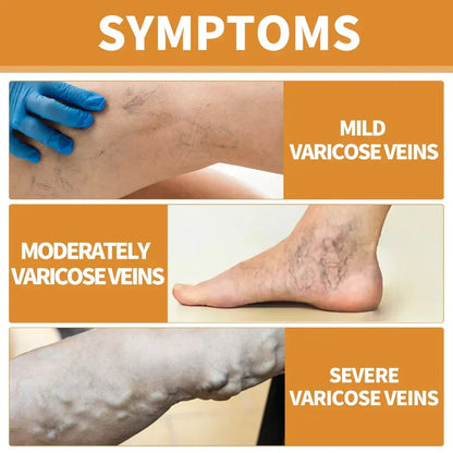 Turmeric Vericose Vein Relief Spray ( Imported )