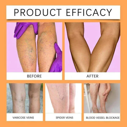 Turmeric Vericose Vein Relief Spray ( Imported )