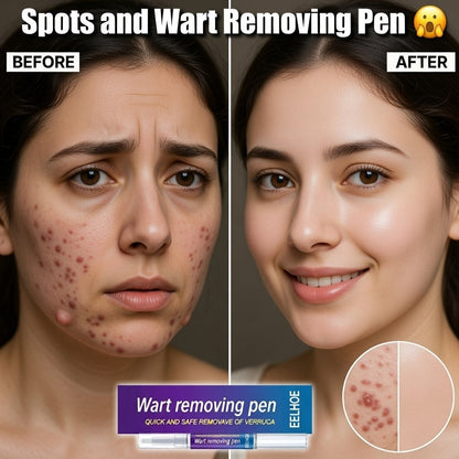 Warts & Moles Remover Pen (14 Days Money Back Guarantee)