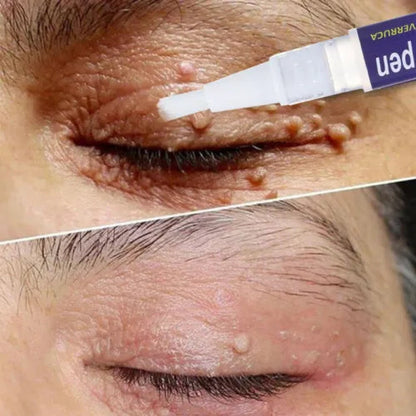 Warts, Moles & Skin Tag Remover Pen